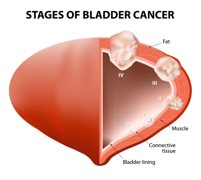 Diagram showing the stages of bladder cancer. Image Credit: Designua / Shutterstock